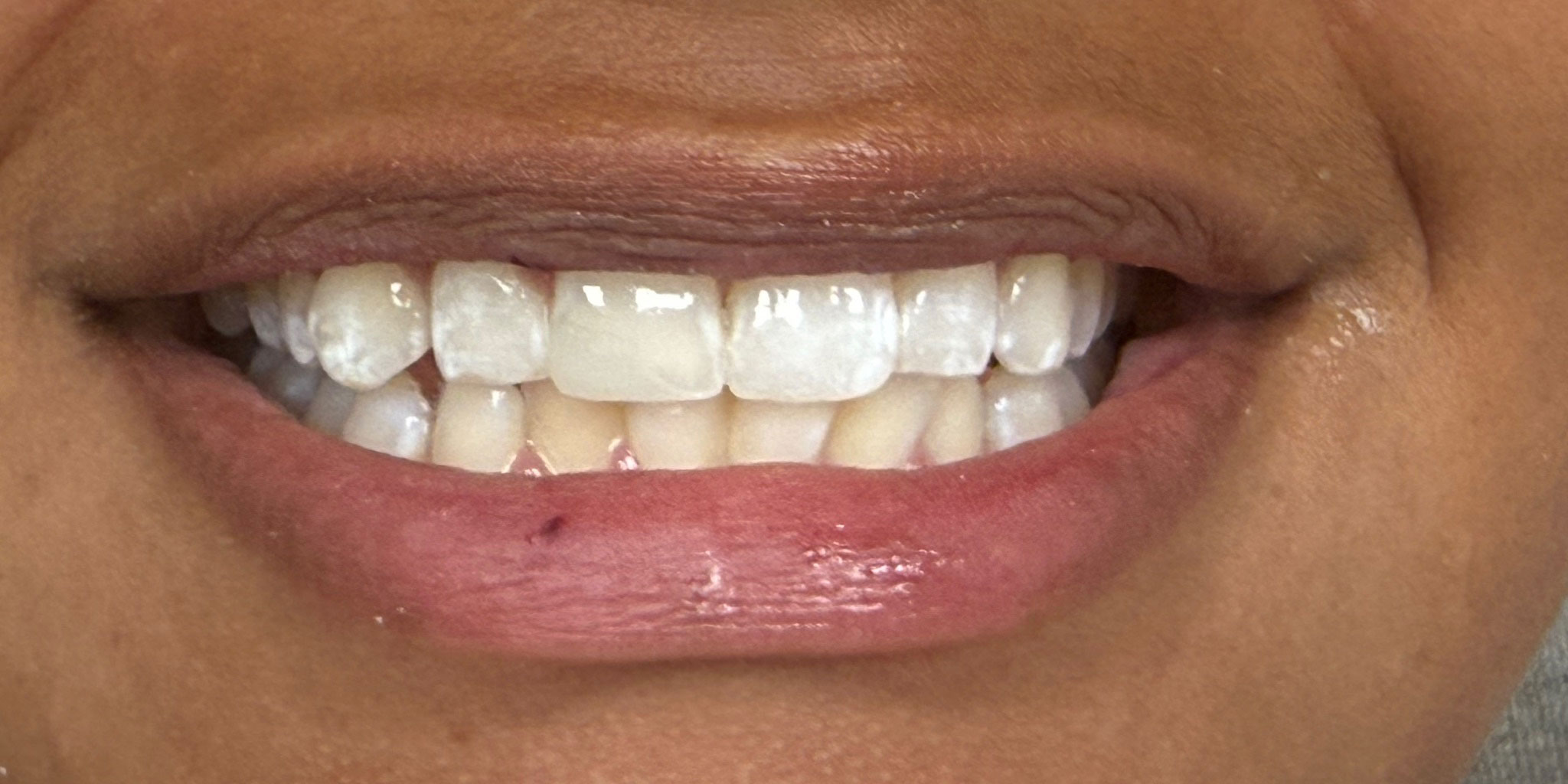 Smile Gallery